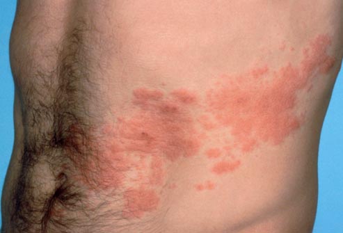 Image result for ‫بیماری پوستی ناحیه شکم‬‎