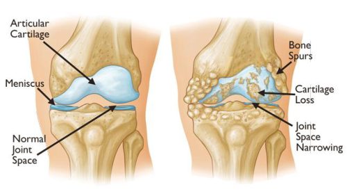 Knee Arthritis آرتروز زانو