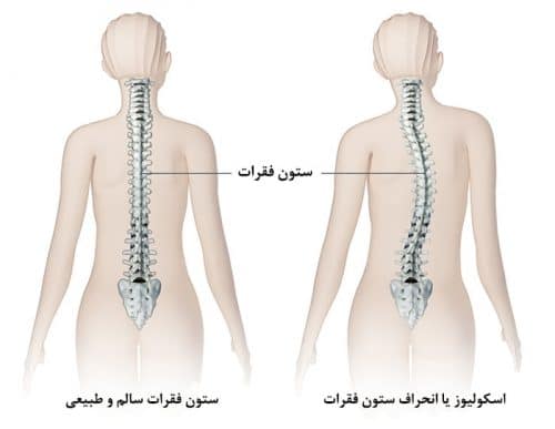 اسکولیوز و کمردرد