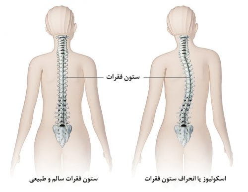 انحراف ستون فقرات