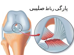 علائم پارگی رباط صلیبی زانو