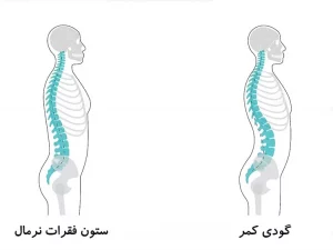قوس کمر و کمردرد