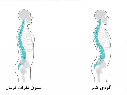 قوس کمر و کمردرد