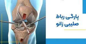 درمان پارگی رباط صلیبی زانو