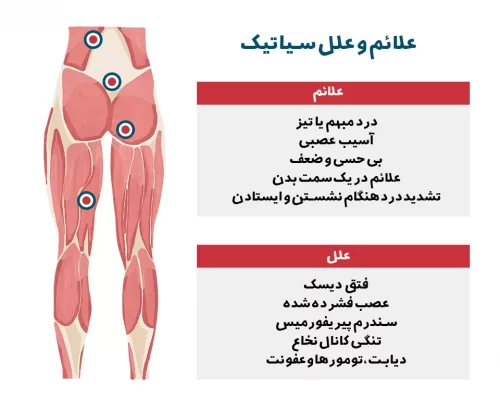 درد سیاتیک