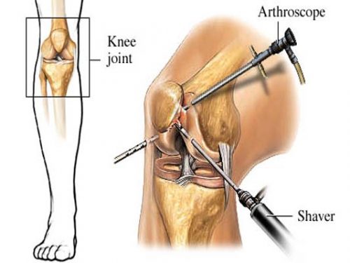 Arthroscopy زانو