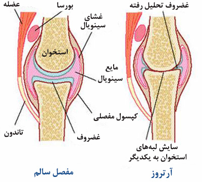 آرتروز زانو