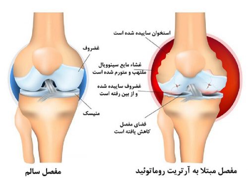 روماتیسم 
