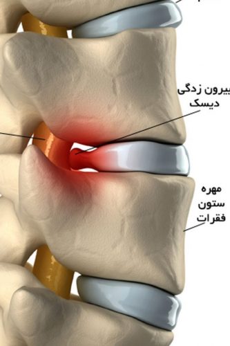 دیسک کمر