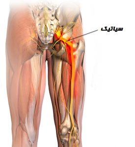 سیاتیک چیست