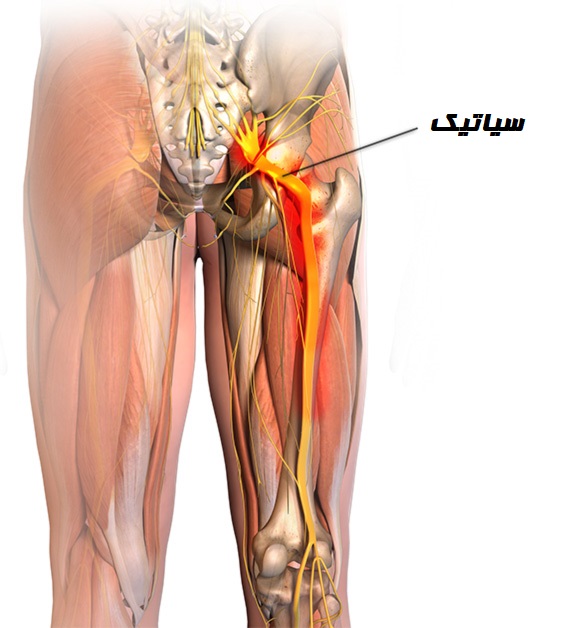 سیاتیک چیست