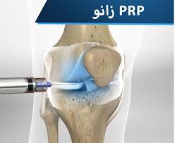 پی‌ آر پی زانو