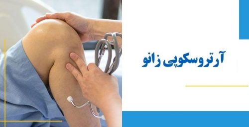 آرتروسکوپی