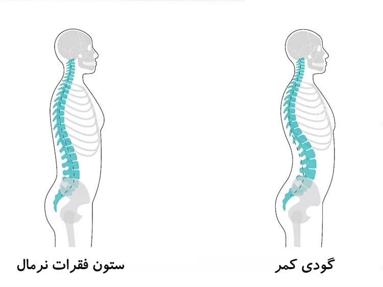 قوس کمر و کمردرد