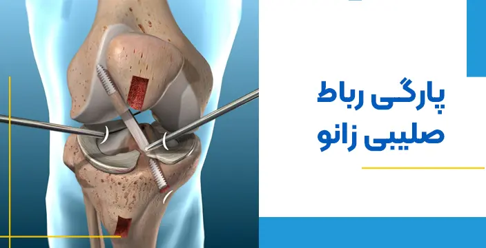 درمان پارگی رباط صلیبی زانو